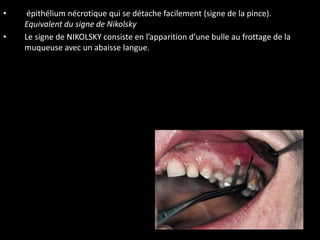 • épithélium nécrotique qui se détache facilement (signe de la pince).
Equivalent du signe de Nikolsky
• Le signe de NIKOLSKY consiste en l’apparition d’une bulle au frottage de la
muqueuse avec un abaisse langue.
 