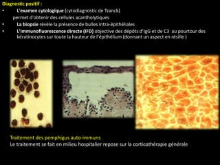 Diagnostic positif :
• L'examen cytologique (cytodiagnostic de Tzanck)
permet d'obtenir des cellules acantholytiques
• La biopsie révèle la présence de bulles intra-épithéliales
• L’immunofluorescence directe (IFD) objective des dépôts d’IgG et de C3 au pourtour des
kératinocytes sur toute la hauteur de l’épithélium (donnant un aspect en résille )
Traitement des pemphigus auto-immuns
Le traitement se fait en milieu hospitalier repose sur la corticothérapie générale
 