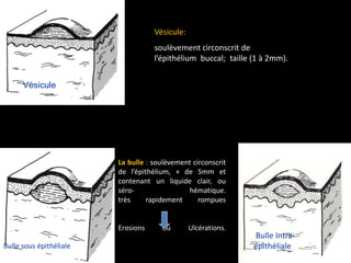 La bulle : soulèvement circonscrit
de l’épithélium, + de 5mm et
contenant un liquide clair, ou
séro- hématique.
très rapidement rompues
Erosions ou Ulcérations.
Bulle Intra-
épithéliale
Vésicule
Bulle sous épithéliale
Vésicule:
soulèvement circonscrit de
l’épithélium buccal; taille (1 à 2mm).
 