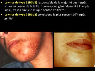 • Le virus de type 1 (HSV1) responsable de la majorité des herpès
situés au dessus de la taille. Il correspond généralement à l'herpès
labial, c'est à dire le classique bouton de fièvre.
• Le virus de type 2 (HSV2) correspond le plus souvent à l'herpès
génital
 