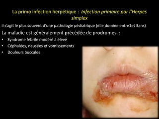 La primo infection herpétique : Infection primaire par l’Herpes
simplex
il s’agit le plus souvent d’une pathologie pédiatrique (elle domine entre1et 3ans)
La maladie est généralement précédée de prodromes :
• Syndrome fébrile modéré à élevé
• Céphalées, nausées et vomissements
• Douleurs buccales
 