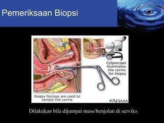 Pemeriksaan Biopsi
Dilakukan bila dijumpai mass/benjolan di serviks
 