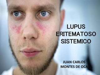 JUAN CARLOS
MONTES DE OCA
LUPUS
ERITEMATOSO
SISTEMICO
 