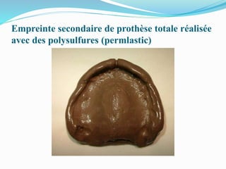 Empreinte secondaire de prothèse totale réalisée
avec des polysulfures (permlastic)
 