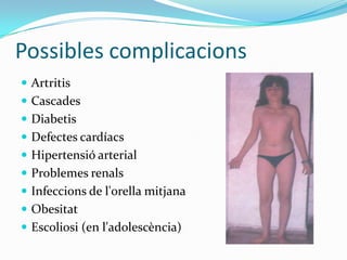 Possibles complicacionsArtritisCascadesDiabetisDefectes cardíacsHipertensió arterialProblemes renalsInfeccions de l'orella mitjanaObesitatEscoliosi (en l'adolescència)