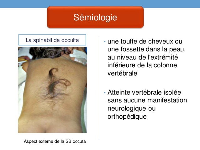 Les Malformations Congenitales Du Systeme Nerveux Central