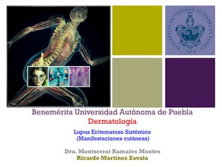 +
Benemérita Universidad Autónoma de Puebla
Dermatología
Lupus Eritematoso Sistémico
(Manifestaciones cutáneas)
Dra. Montserrat Ramales Montes
Ricardo Martínez Zavala
 