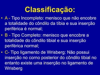 Classificação:
• A - Tipo Incompleto: menisco que não encobre
a totalidade do côndilo da tíbia e sua inserção
periférica é normal;
• B - Tipo Completo: menisco que encobre a
totalidade do côndilo tibial e sua inserção
periférica normal;
• C- Tipo ligamento de Wrisberg: Não possui
inserção no corno posterior do côndilo tibial no
entanto existe uma inserção no ligamento de
Wrisberg
 