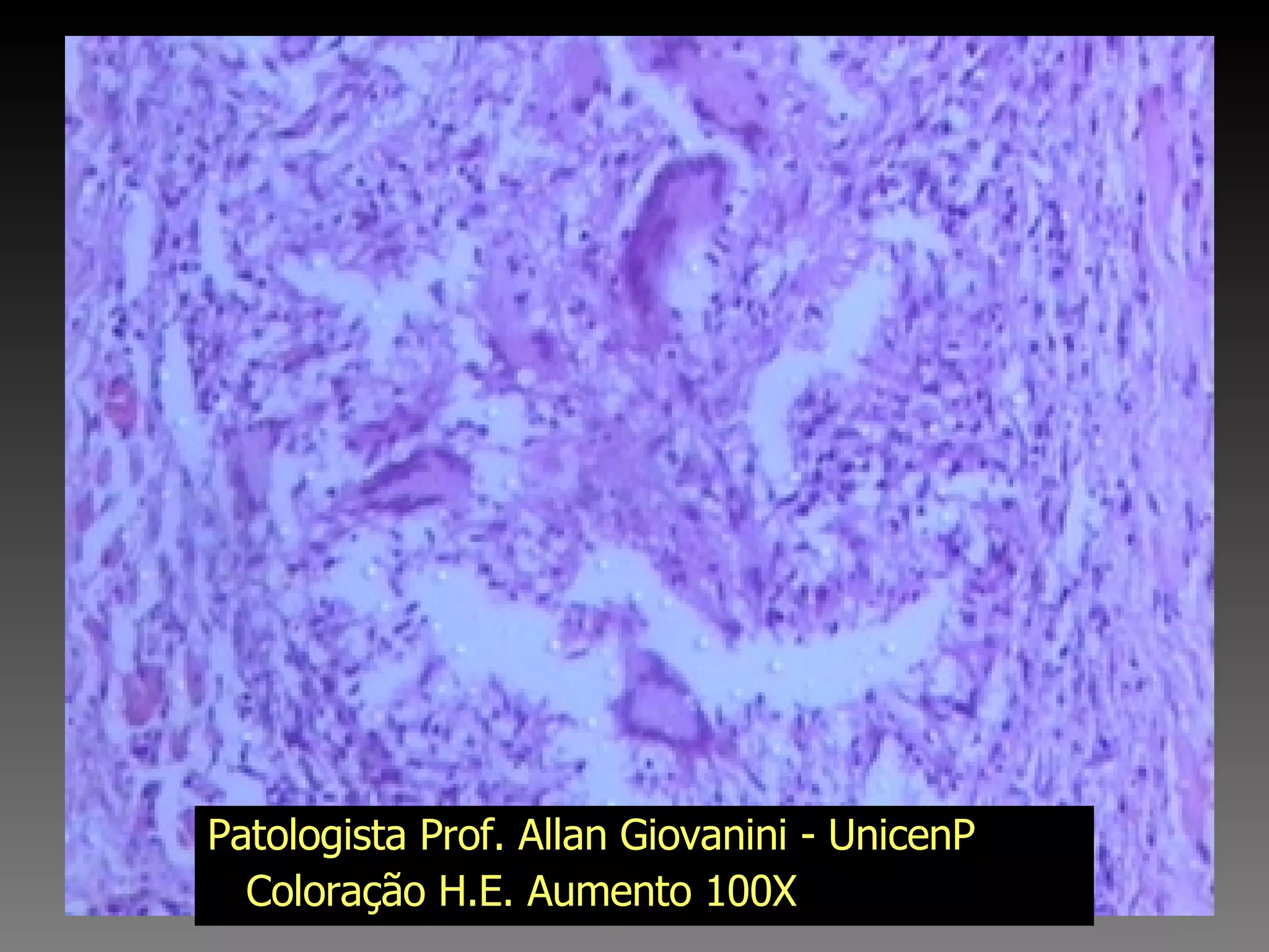 Patologista Prof. Allan Giovanini - UnicenP Coloração H.E. Aumento 100X 