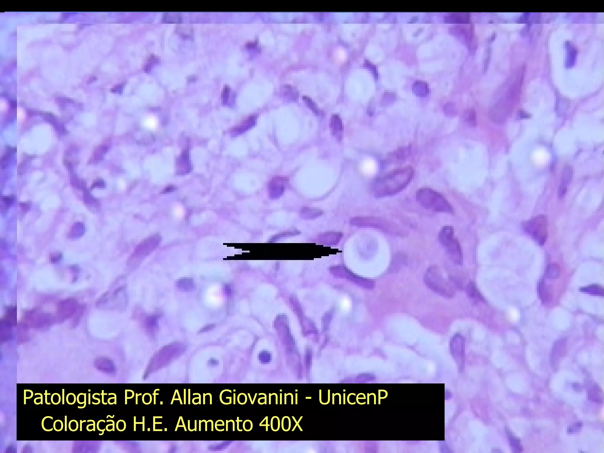 Patologista Prof. Allan Giovanini - UnicenP Coloração H.E. Aumento 400X 