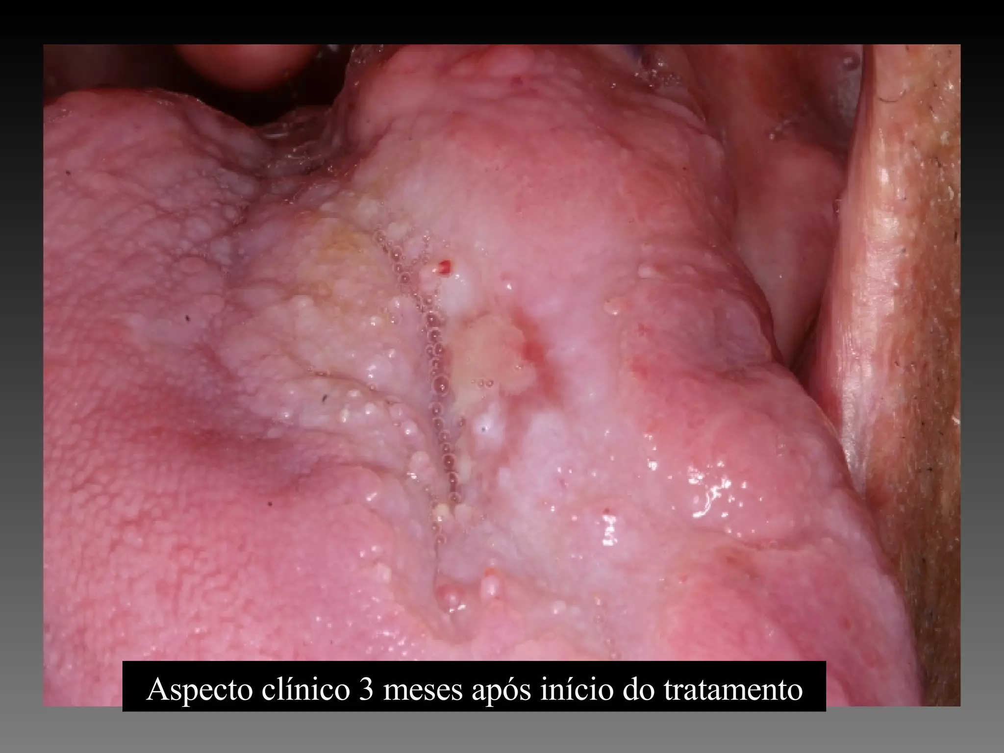 Aspecto clínico 3 meses após início do tratamento 