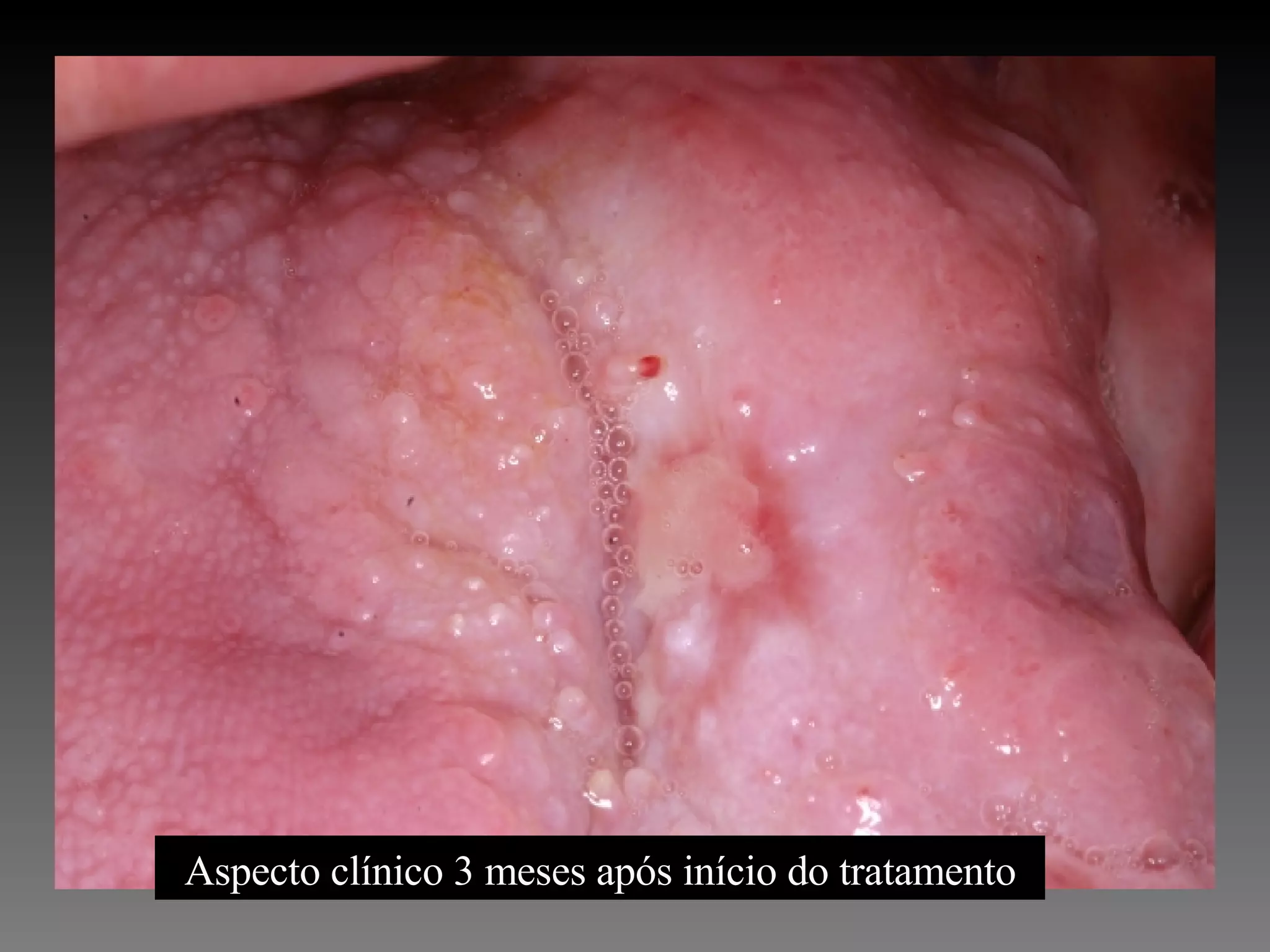 Aspecto clínico 3 meses após início do tratamento 