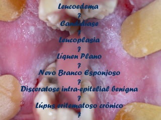 Leucoedema
                 ?
            Candidíase
                 ?
           Leucoplasia
                 ?
          Líquen Plano
                 ?
     Nevo Branco Esponjoso
                 ?
Disceratose intra-epitelial benigna
                 ?
    Lúpus eritematoso crônico
                 ?
 