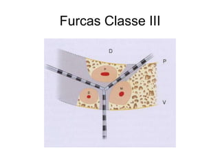 Furcas Classe III

 