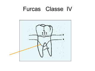 Furcas Classe IV

 