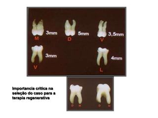 Importancia critica na
seleção do caso para a
terapia regenerativa

 