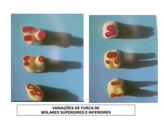 VARIAÇÕES DE FURCA DE
MOLARES SUPERIORES E INFERIORES

 