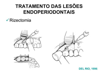 TRATAMENTO DAS LESÕES
ENDOPERIODONTAIS
Rizectomia

DEL RIO, 1996

 