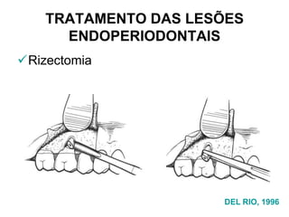 TRATAMENTO DAS LESÕES
ENDOPERIODONTAIS
Rizectomia

DEL RIO, 1996

 