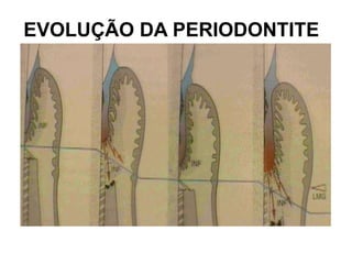EVOLUÇÃO DA PERIODONTITE

 