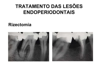TRATAMENTO DAS LESÕES
ENDOPERIODONTAIS
Rizectomia

 