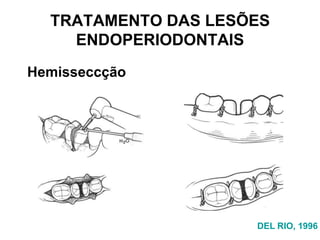 TRATAMENTO DAS LESÕES
ENDOPERIODONTAIS
Hemisseccção

DEL RIO, 1996

 