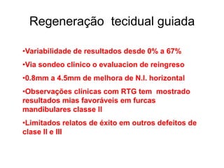 Regeneração tecidual guiada
•Variabilidade de resultados desde 0% a 67%
•Via sondeo clinico o evaluacion de reingreso
•0.8mm a 4.5mm de melhora de N.I. horizontal
•Observações clínicas com RTG tem mostrado
resultados mias favoráveis em furcas
mandibulares classe II
•Limitados relatos de éxito em outros defeitos de
clase II e III

 