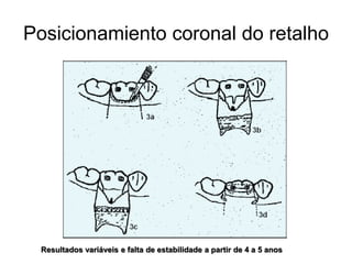Posicionamiento coronal do retalho

Resultados variáveis e falta de estabilidade a partir de 4 a 5 anos

 