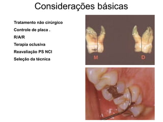 Considerações básicas
Tratamento não cirúrgico
Controle de placa .
R/A/R
Terapia oclusiva
Reavaliação PS NCI
Seleção da técnica

 