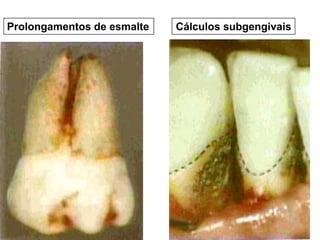 Prolongamentos de esmalte

Cálculos subgengivais

 