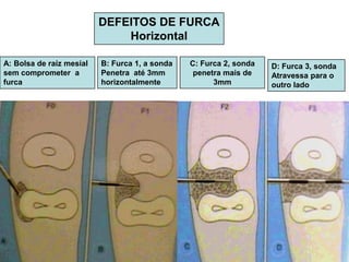 DEFEITOS DE FURCA
Horizontal
A: Bolsa de raíz mesial
sem comprometer a
furca

B: Furca 1, a sonda
Penetra até 3mm
horizontalmente

C: Furca 2, sonda
penetra mais de
3mm

D: Furca 3, sonda
Atravessa para o
outro lado

 