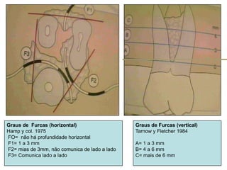 Graus de Furcas (horizontal)
Hamp y col. 1975
FO= não há profundidade horizontal
F1= 1 a 3 mm
F2= mias de 3mm, não comunica de lado a lado
F3= Comunica lado a lado

Graus de Furcas (vertical)
Tarnow y Fletcher 1984
A= 1 a 3 mm
B= 4 a 6 mm
C= mais de 6 mm

 