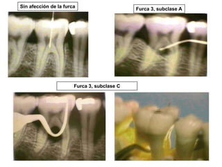 Sin afección de la furca

Furca 3, subclase C

Furca 3, subclase A

 