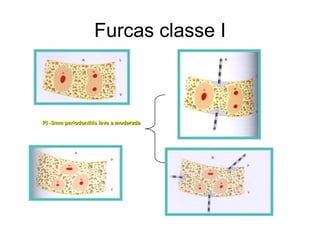 Furcas classe I

PI -3mm periodontitis leve a moderada

 