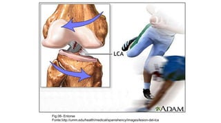 Fig.06- Entorse
Fonte:http://umm.edu/health/medical/spanishency/images/lesion-del-lca

 