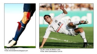 Fig. 07- Entorse
Fonte: fernandatirone.blogspot.com

Fig.08- Lesão de Maikon Leite
Fonte: www.ricardosaibun.com.br

 
