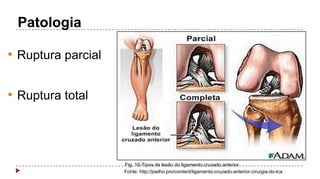 Patologia

• Ruptura parcial
• Ruptura total

Fig. 10-Tipos de lesão do ligamento cruzado anterior
Fonte: http://joelho.pro/content/ligamento-cruzado-anterior-cirurgia-do-lca

 