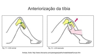 Anteriorização da tíbia

Fig. 11 – LCA normal

Fig. 12 – LCA lesionado

Ambas, fonte: http://www.vitorcaine.com/patologias/joelho/instabilidade/funcao.htm

 
