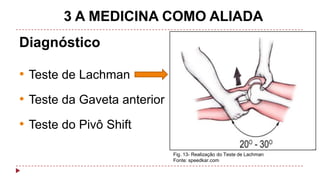3 A MEDICINA COMO ALIADA
Diagnóstico

• Teste de Lachman
• Teste da Gaveta anterior
• Teste do Pivô Shift
Fig. 13- Realização do Teste de Lachman
Fonte: speedkar.com

 