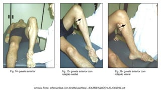 Fig. 14- gaveta anterior

Fig. 15- gaveta anterior com
rotação medial

Fig. 16- gaveta anterior com
rotação lateral

Ambas, fonte: jeffersonleal.com.br/effe/userfiles/.../EXAME%20DO%20JOELHO.pdf

 