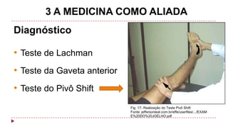 3 A MEDICINA COMO ALIADA
Diagnóstico

• Teste de Lachman
• Teste da Gaveta anterior
• Teste do Pivô Shift
Fig. 17- Realização do Teste Pivô Shift
Fonte: jeffersonleal.com.br/effe/userfiles/.../EXAM
E%20DO%20JOELHO.pdf

 