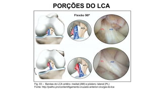 PORÇÕES DO LCA

Fig. 03 – Bandas do LCA antêro- medial (AM) e póstero- lateral (PL)
Fonte: http://joelho.pro/content/ligamento-cruzado-anterior-cirurgia-do-lca

 