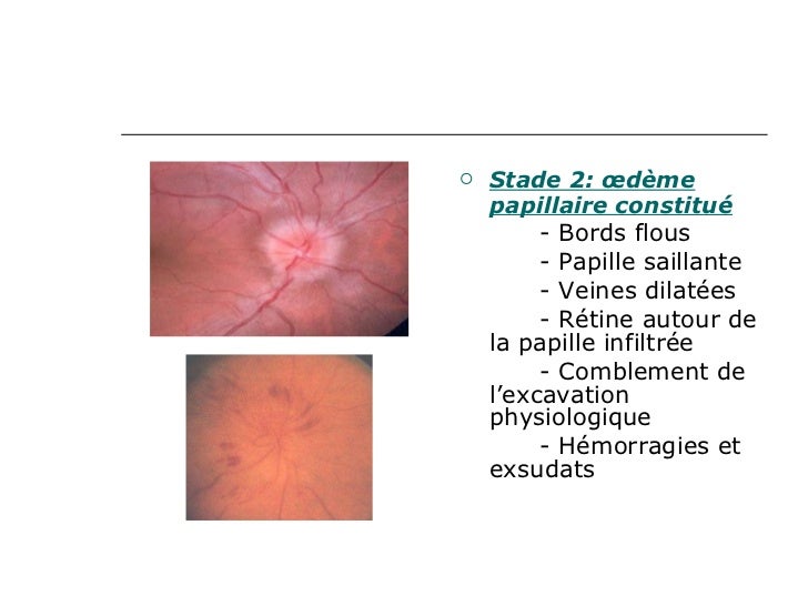 Les oedèmes papillaires accompagnés