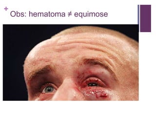 +
Obs: hematoma ≠ equimose
 
