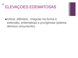 +
ELEVAÇOES EDEMATOSAS
Urtica: efêmera , irregular na forma e
extensão, eritematosa e pruriginosa (edema
dérmico circunscrito)
 