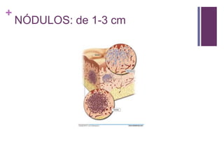 +
NÓDULOS: de 1-3 cm
 