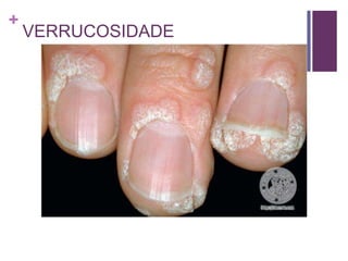 +
VERRUCOSIDADE
 