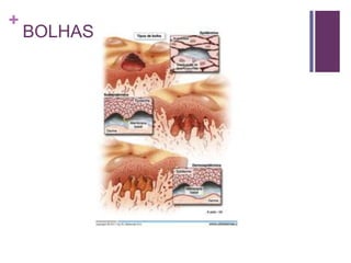 +
BOLHAS
 