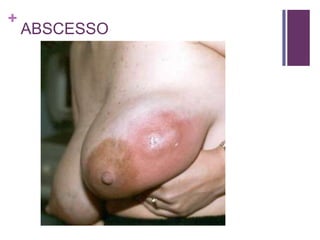 +
ABSCESSO
 