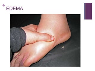 +
EDEMA
 